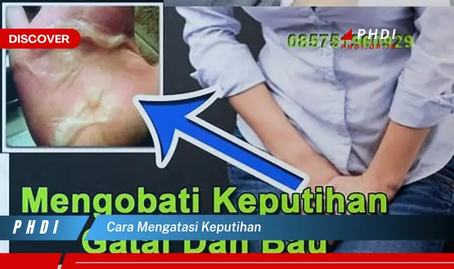 cara mengatasi keputihan