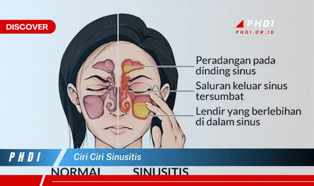 ciri ciri sinusitis