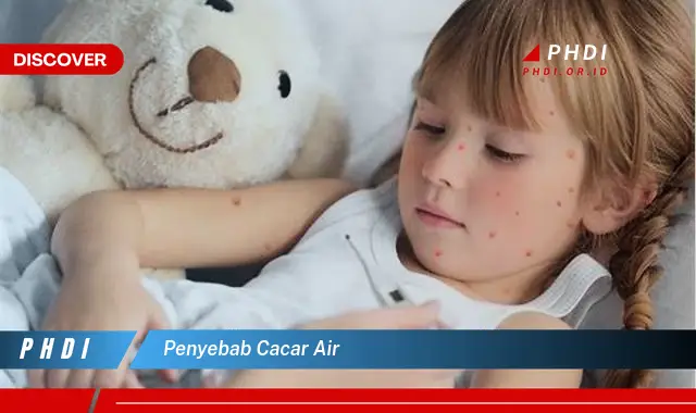 penyebab cacar air