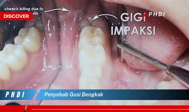 penyebab gusi bengkak